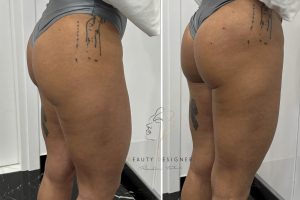 Bum Lifting Bum Lifting