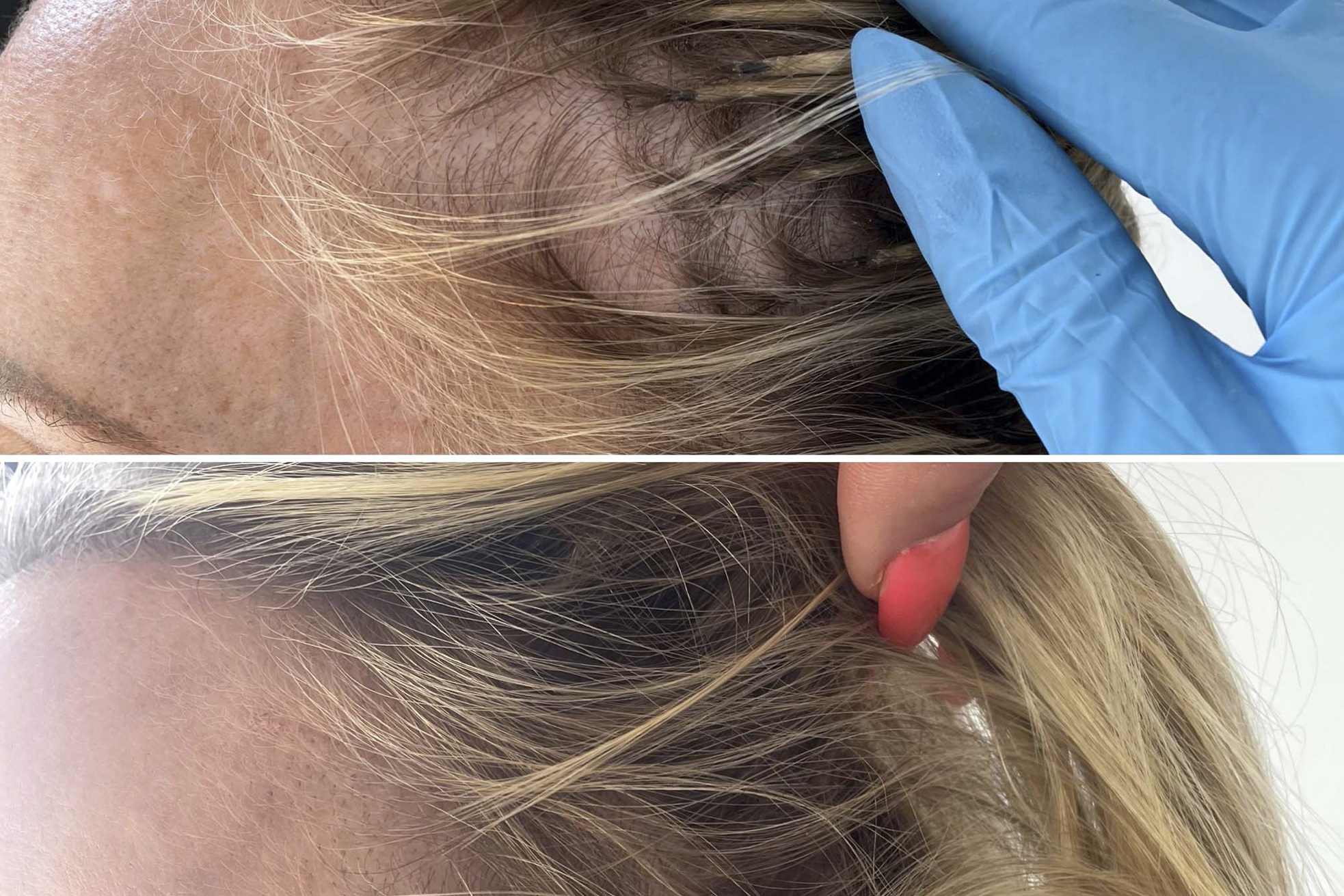 Hair Loss injections Beauty Designer